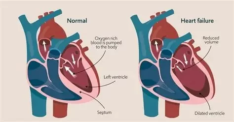 Congestive Heart Failure Symptoms, Stages, and Treatment Options