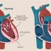 Congestive Heart Failure Symptoms, Stages, and Treatment Options