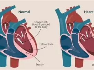 Congestive Heart Failure Symptoms, Stages, and Treatment Options