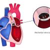 Heart Valve Replacement and Repair: Fixing Structural Issues Explained