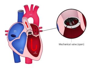 Heart Valve Replacement and Repair: Fixing Structural Issues Explained