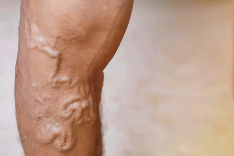 Varicose Veins and Heart Health: Are They Connected?