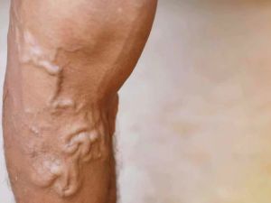 Varicose Veins and Heart Health: Are They Connected?