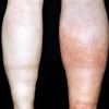 Deep Vein Thrombosis: Understanding and Preventing Blood Clots