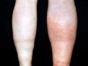 Deep Vein Thrombosis: Understanding and Preventing Blood Clots