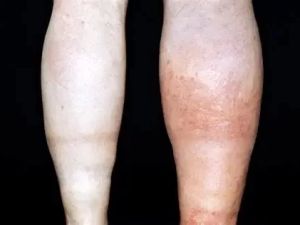 Deep Vein Thrombosis (DVT) and Pulmonary Embolism (PE): Understanding Blood Clots