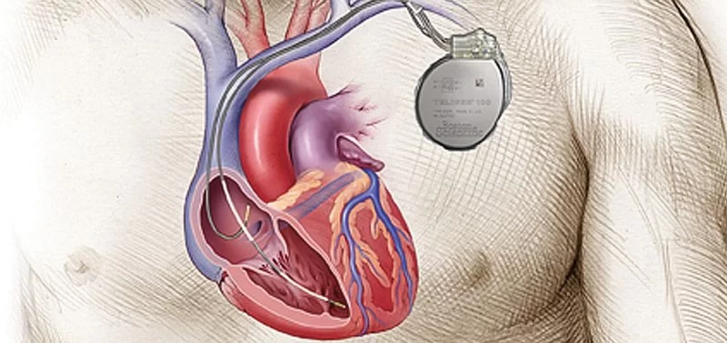 Living with Implantable Heart Devices: Pacemakers and Defibrillators Explained