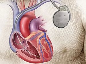 Living with Implantable Heart Devices: Pacemakers and Defibrillators Explained