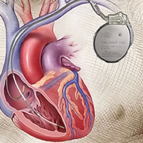 Living with Implantable Heart Devices: Pacemakers and Defibrillators Explained