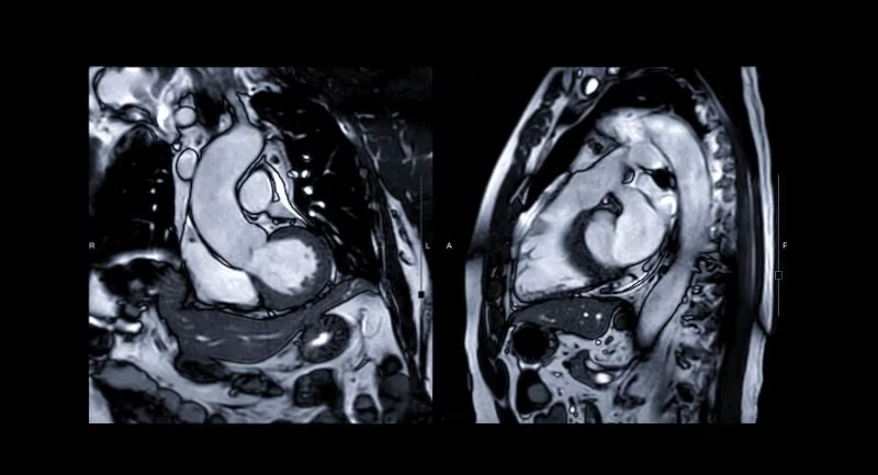 Cardiac MRI: Detailed Imaging of Your Heart for Better Health