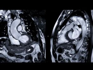 Cardiac MRI: Detailed Imaging of Your Heart for Better Health