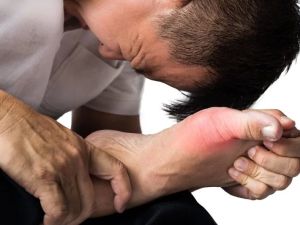 Gout: Managing Inflammation for Heart Protection