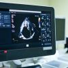 Echocardiogram Explained: What This Important Test Reveals About Your Heart