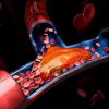 Pulmonary Embolism: A Serious Complication of DVT