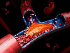 Pulmonary Embolism: A Serious Complication of DVT