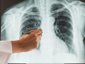 How to Know if You Have an Enlarged Heart