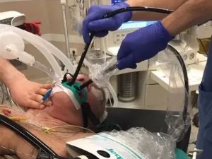 What Is a Transesophageal Echocardiogram? Everything You Need to Know